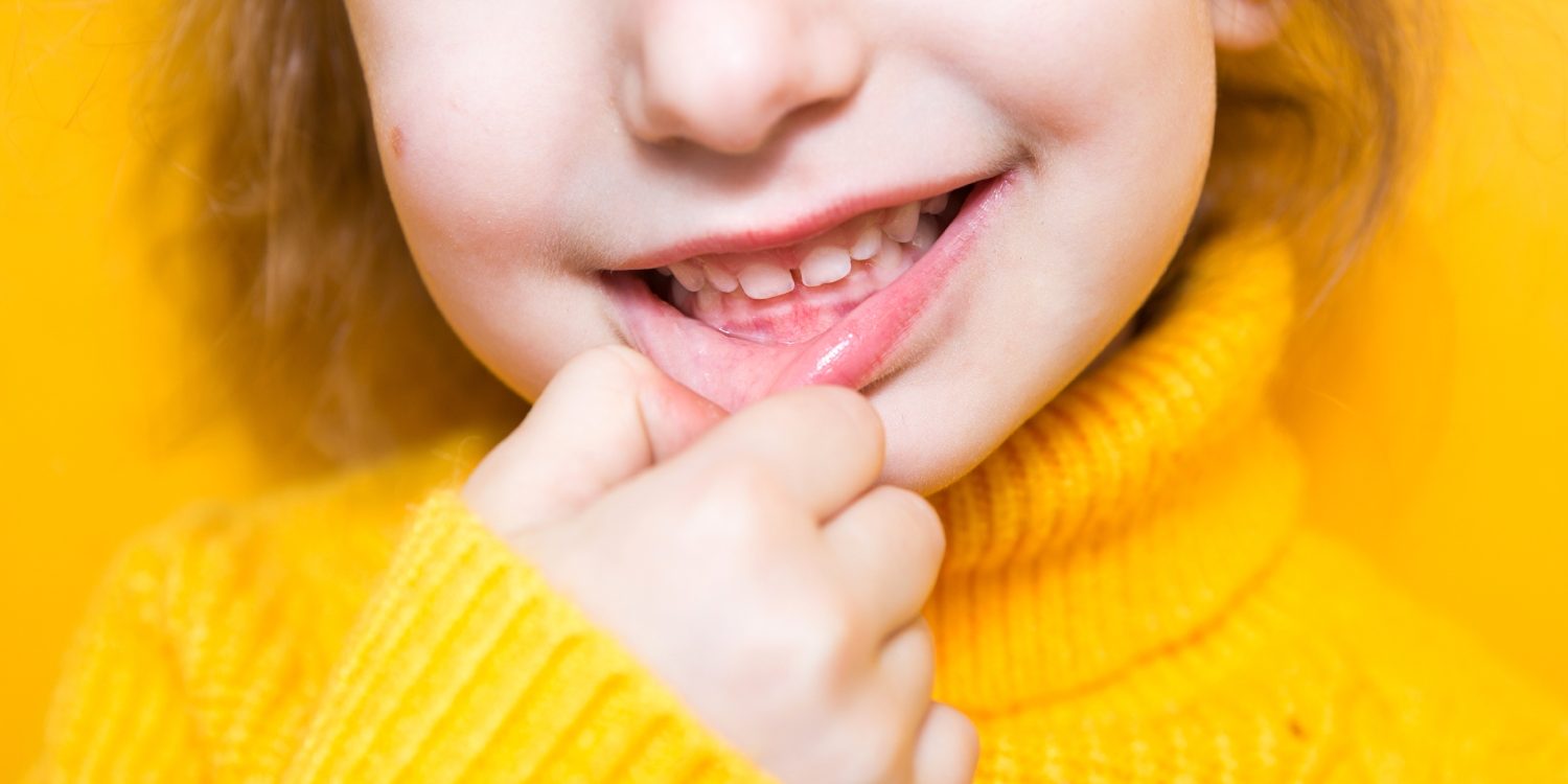 Concept per urgenze ortodontiche nei bambini - Dr. Chiara Piccioni