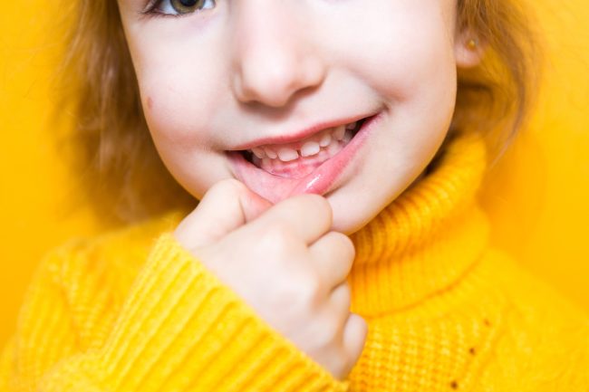 Concept per urgenze ortodontiche nei bambini - Dr. Chiara Piccioni