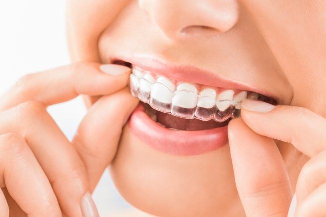 Invisalign®, l'allineatore dentale trasparente