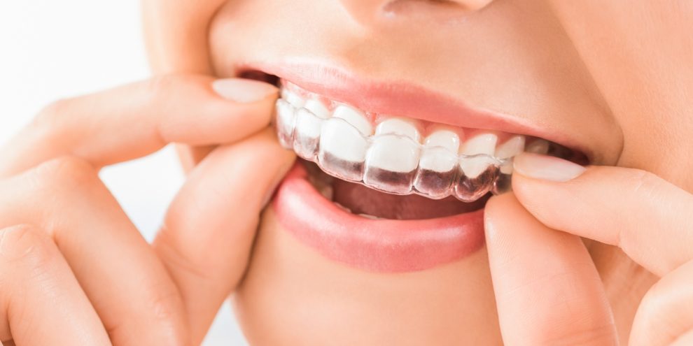 Invisalign®, l'allineatore dentale trasparente