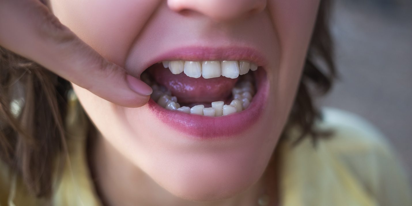 Primo piano di malocclusione dentale - Chiara Piccioni, ortodontista