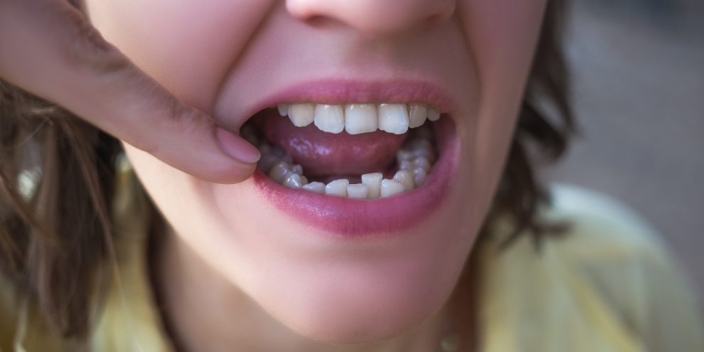 Primo piano di malocclusione dentale - Chiara Piccioni, ortodontista