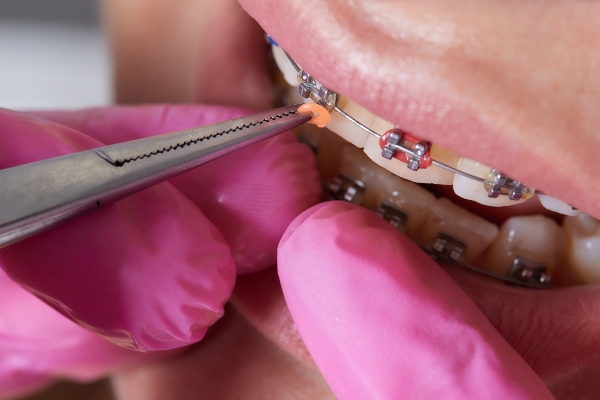 Concept per cosa mangiare con l'apparecchio ai denti - Dott.ssa Chiara Piccioni