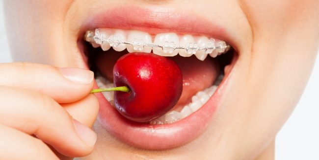 Concept per cosa mangiare con l'apparecchio ai denti - Dott.ssa Chiara Piccioni