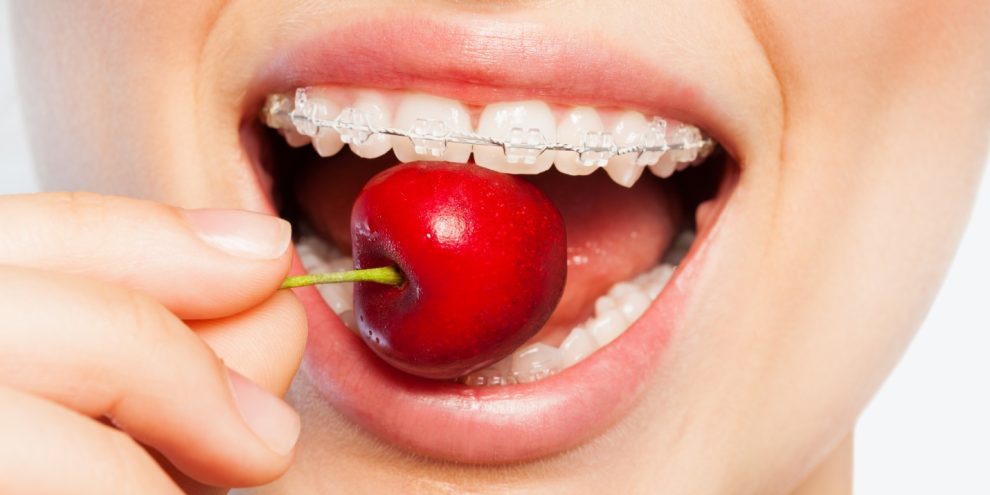 Concept per cosa mangiare con l'apparecchio ai denti - Dott.ssa Chiara Piccioni