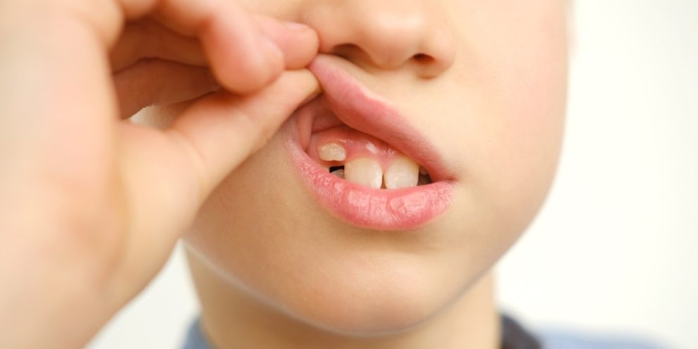 Canino incluso in un bambino - Chiara Piccioni
